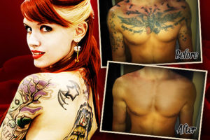 Painless Tattoo Removal Without Using Lasers